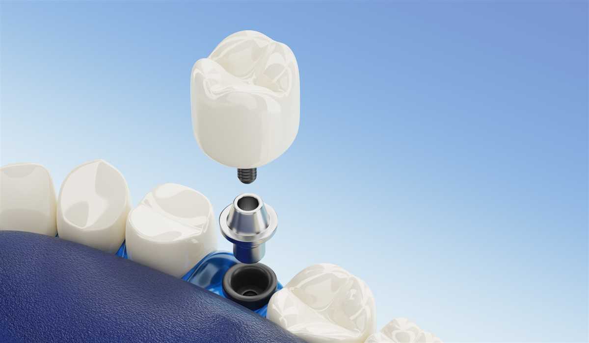 مراحل انجام ایمپلنت دندان