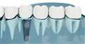 implants ایمپلنت دندان