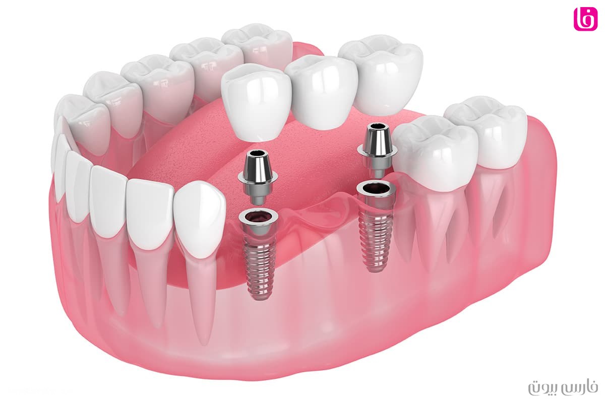 ایمپلنت دندان dental implant
