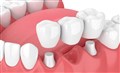 بریج دندان dental bridge