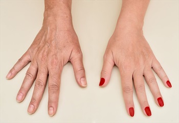 جوانسازی پوست دست
